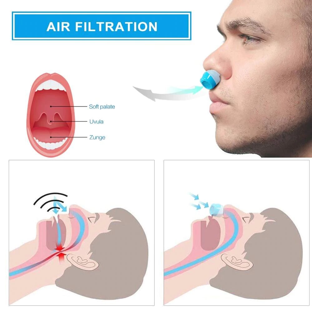 Anti-Snoring Device | Cordless, Maskless Micro-CPAP