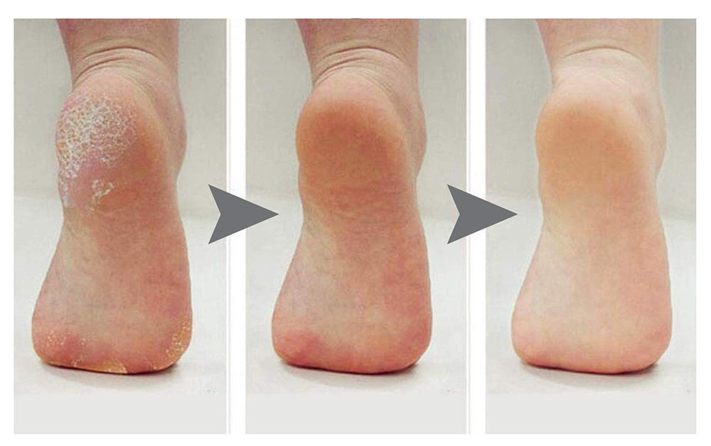 Electric Foot File