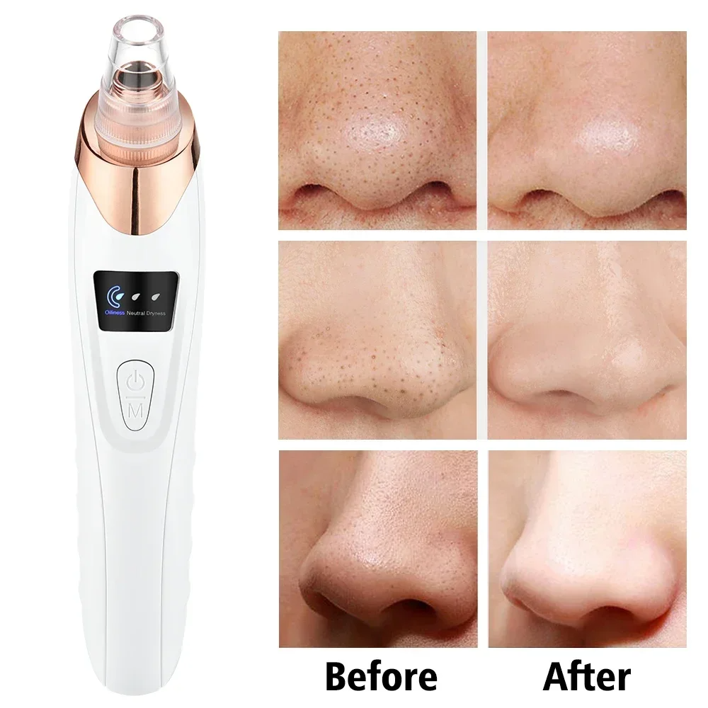 PoreRemover: Rechargeable Smart Blackhead and Whitehead Pore Remover Kit