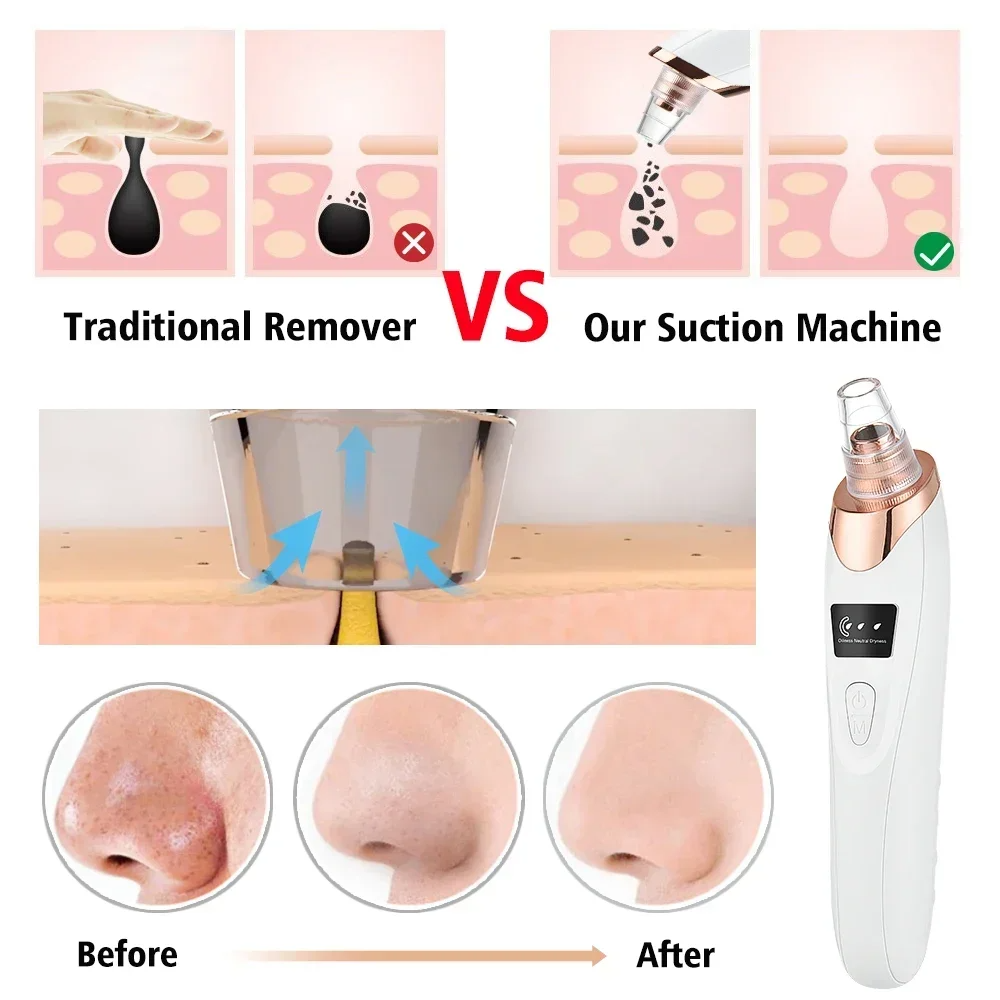 PoreRemover: Rechargeable Smart Blackhead and Whitehead Pore Remover Kit