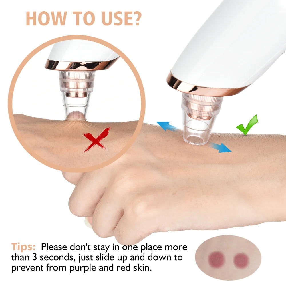 PoreRemover: Rechargeable Smart Blackhead and Whitehead Pore Remover Kit