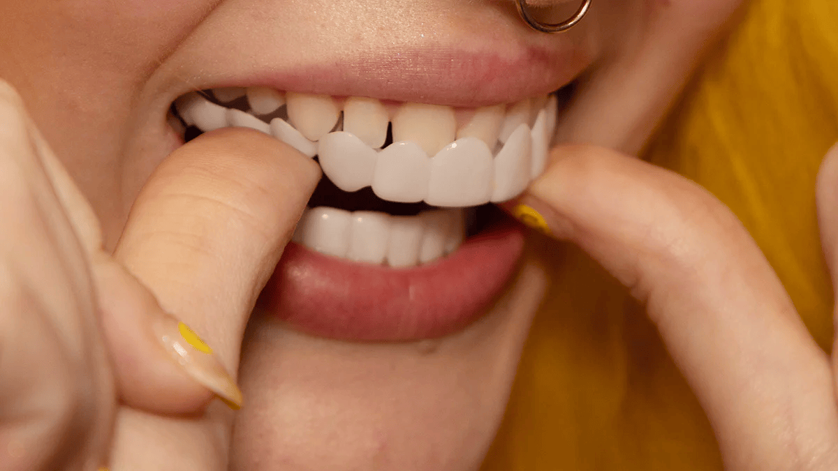 Snap-On Tooth Veneers – Direct Smile Correction for Imperfections