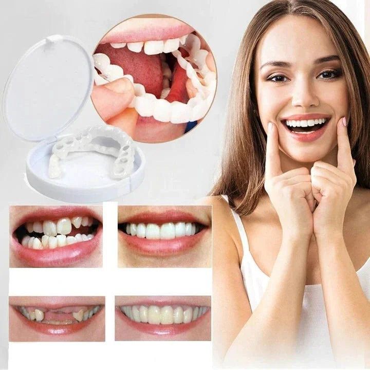 Snap-On Tooth Veneers – Direct Smile Correction for Imperfections