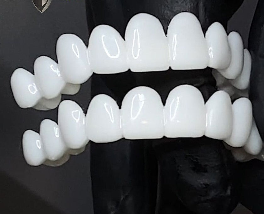 SusanSmith | DentAlign Dental Veneers – Natural Fit and Comfort
