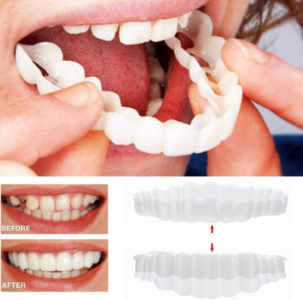 SusanSmith | On Smile Veneers (Upper and Lower Jaw included)
