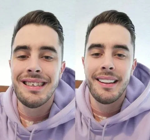 SusanSmith | On Smile Veneers (Upper and Lower Jaw included)