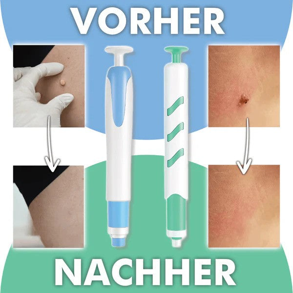 SusanSmith Wart-Free PRO - The Professional Wart Remover