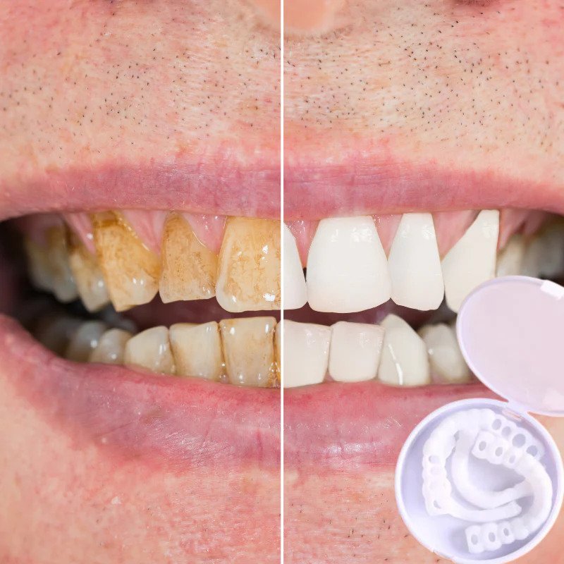 Veneers | Flexible Fit without Adhesive | For Eating, Drinking, and Everyday Use | SnapSmile