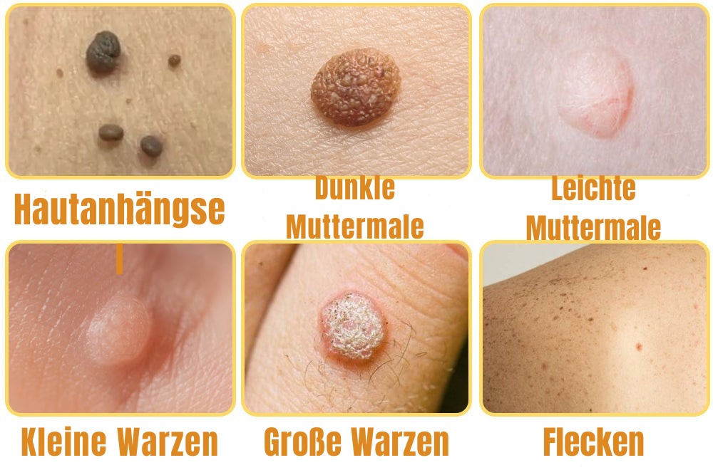 Wart Remover | Wart Spray | Bee Venom Formula | Pain-Free | SkinPurex